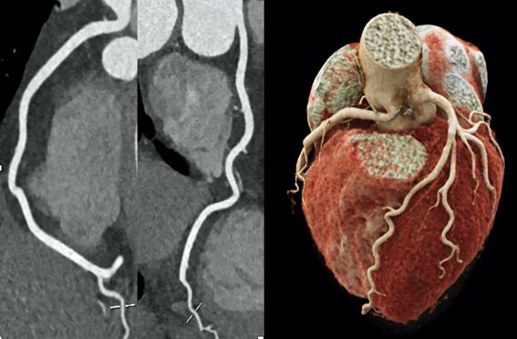 CT Coronary Angiogram