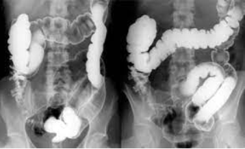 Posições no enema opaco