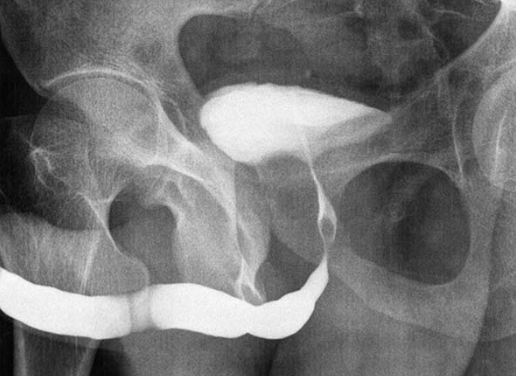 Imagem de Estenose Uretral